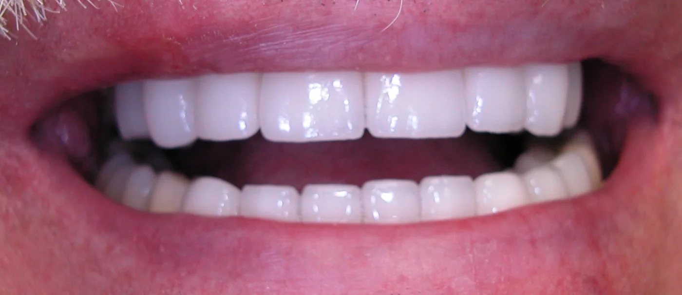 Smile after dental crown treatment