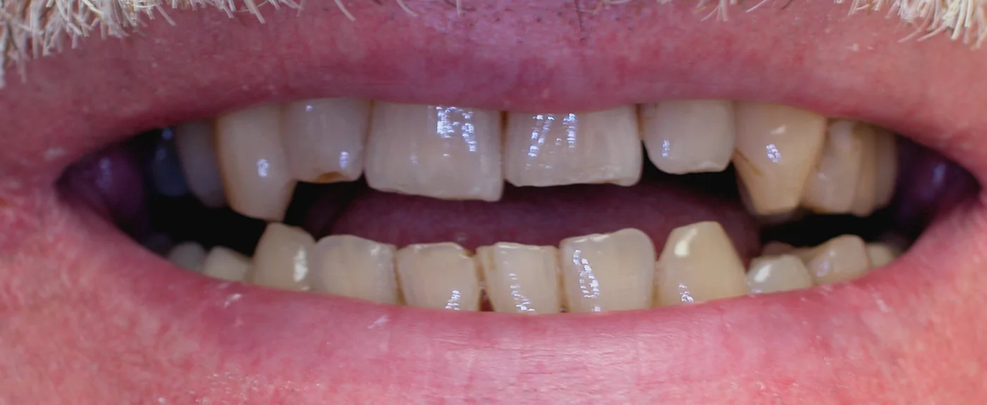 Smile before dental crown treatment