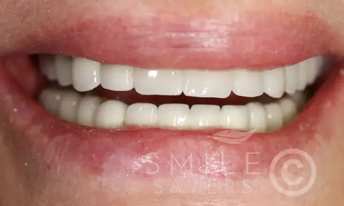 After dental implant treatment