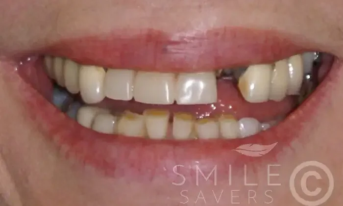 Before dental implant treatment