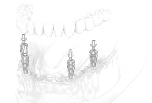 All-On-Four treatment illustration
