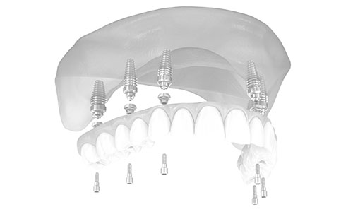 All-On-Six treatment illustration
