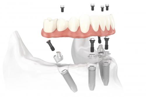 Nobel_Biocare_All-on-4_solution_image_1
